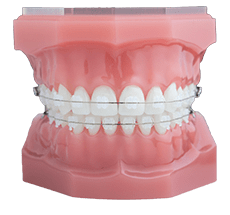 Riverton Ceramic Braces