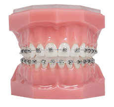 lehi orthodontics - metal braces